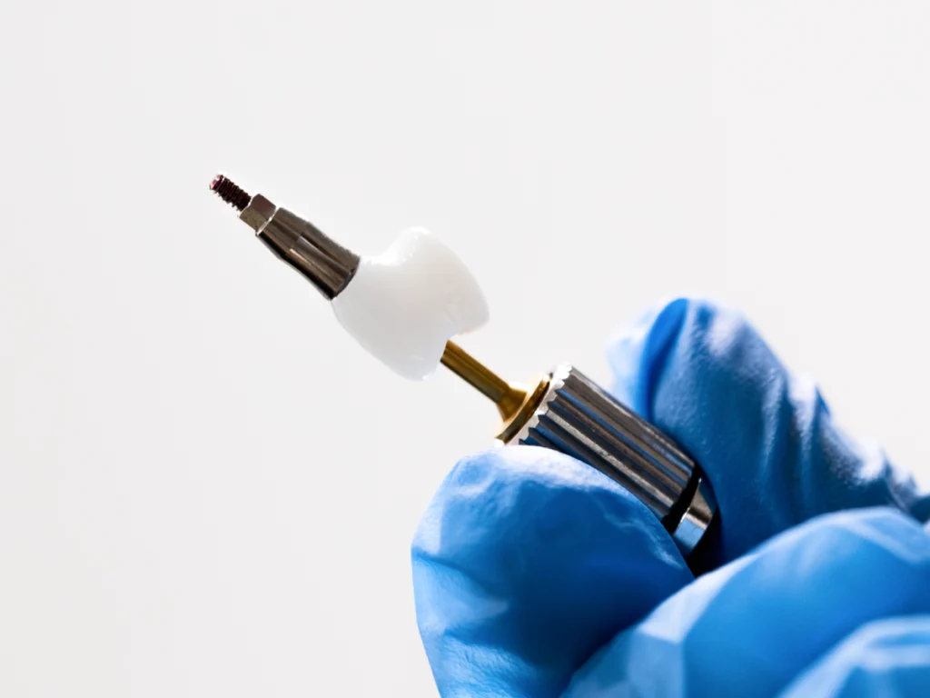 implant dentaire dent manquante Implants dentaires Dr Pierre Mioche - Dentiste à Clermont-Ferrand