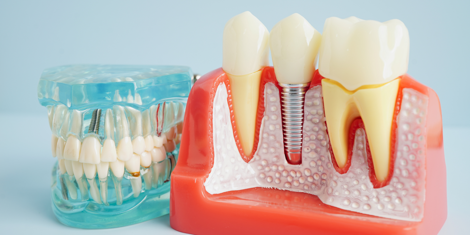 implant dentaire Implants dentaires Dr Pierre Mioche - Dentiste à Clermont-Ferrand