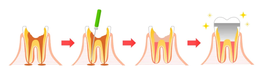 Endodontie | Dévitalisation et retraitement endodontique