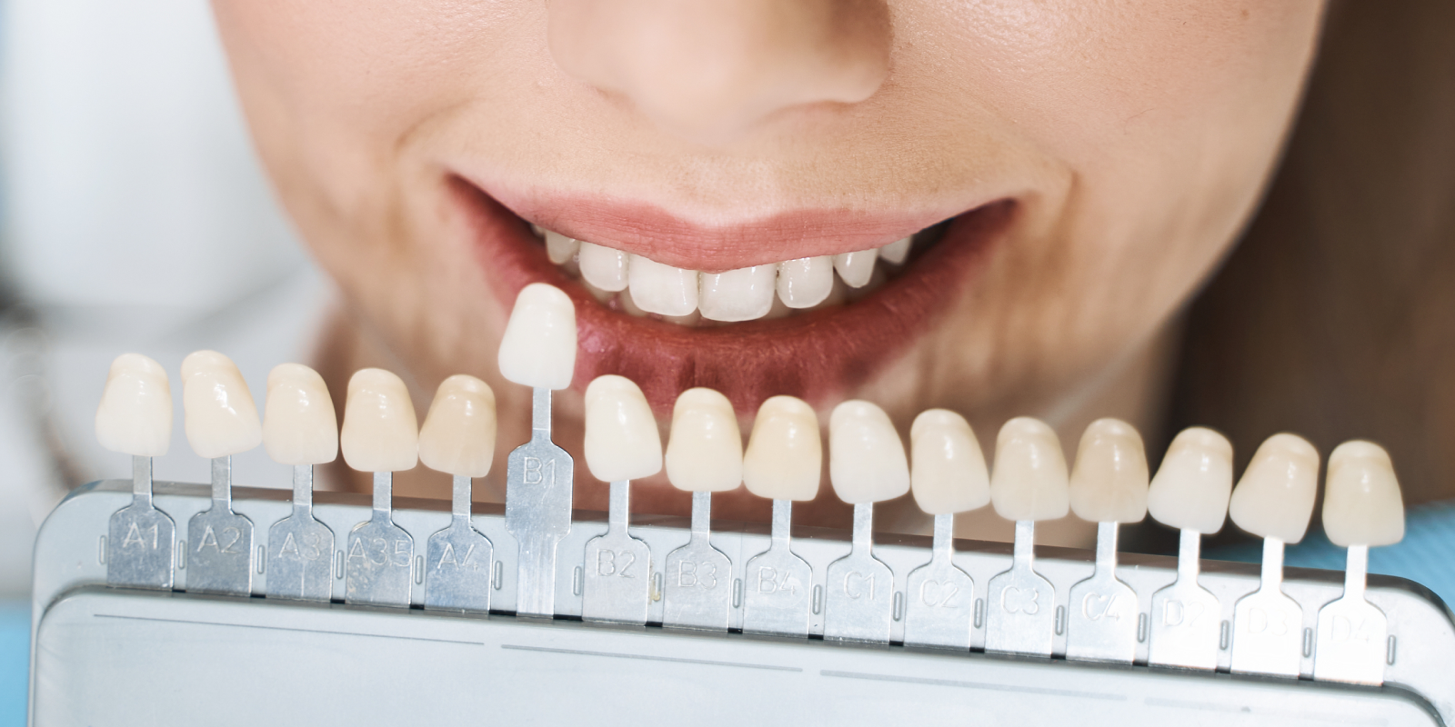 facettes dentaires veneers Couronnes & facettes Dr Pierre Mioche - Dentiste à Clermont-Ferrand