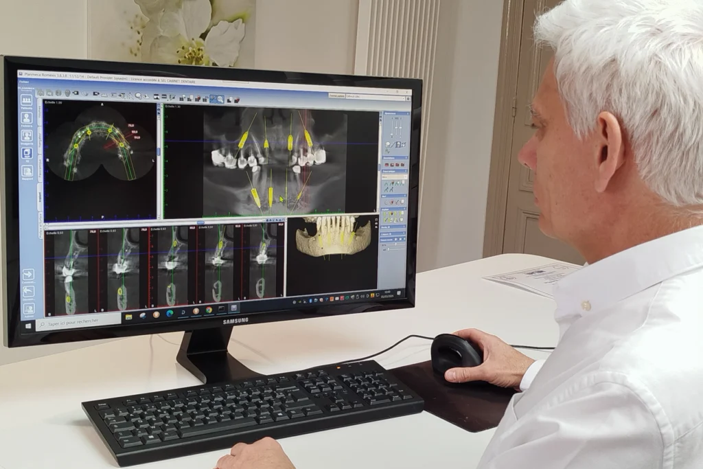 couronnes dentaires implants Conseils pré-opératoires Dr Pierre Mioche - Dentiste à Clermont-Ferrand